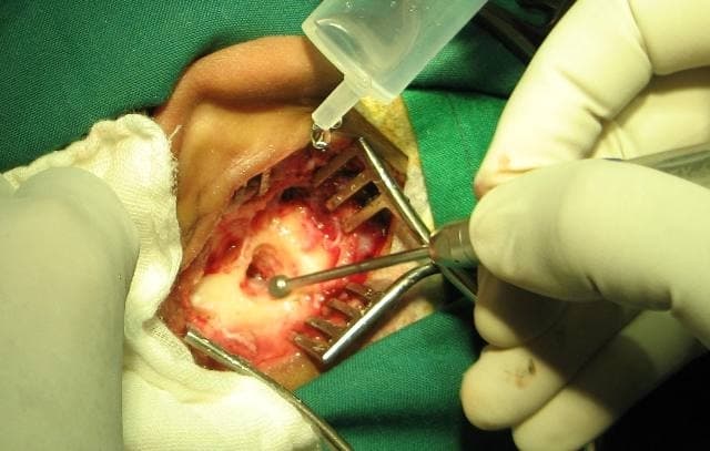 Mastoidectomy cost in Iran