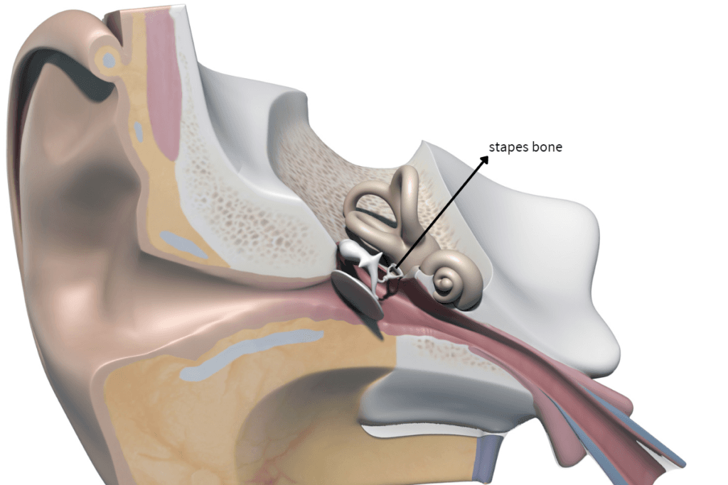 Stapedectomy 