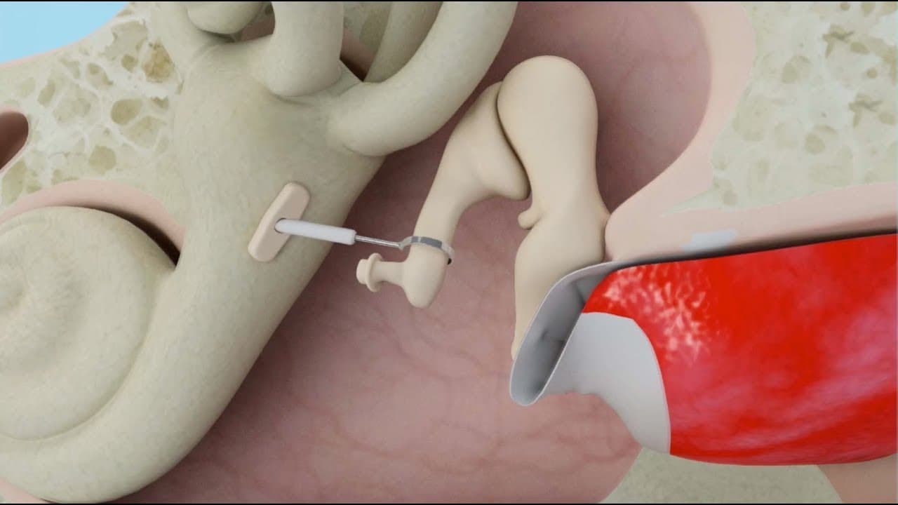 What is stapedectomy surgery?