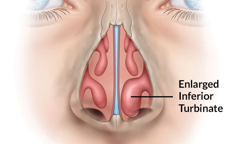 Turbinoplasty 