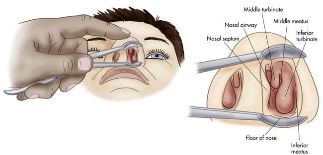 Who needs a Turbinoplasty?
