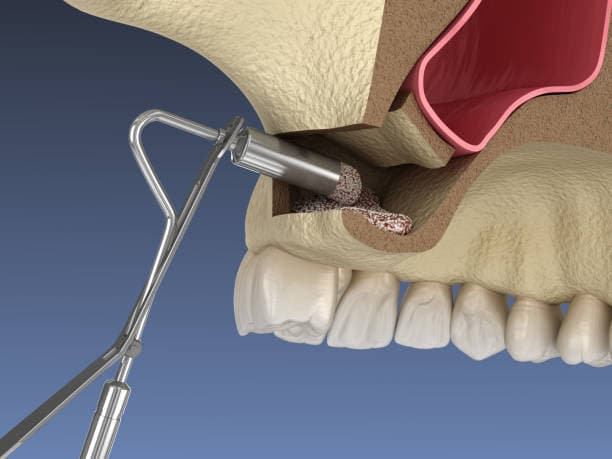 Sinus Surgery 