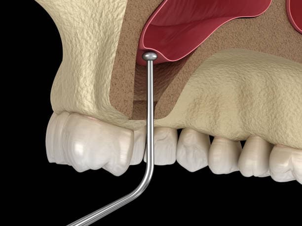 Sinus Surgery cost in Iran
