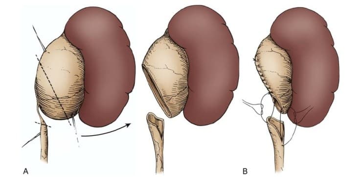Who needs pyeloplasty?