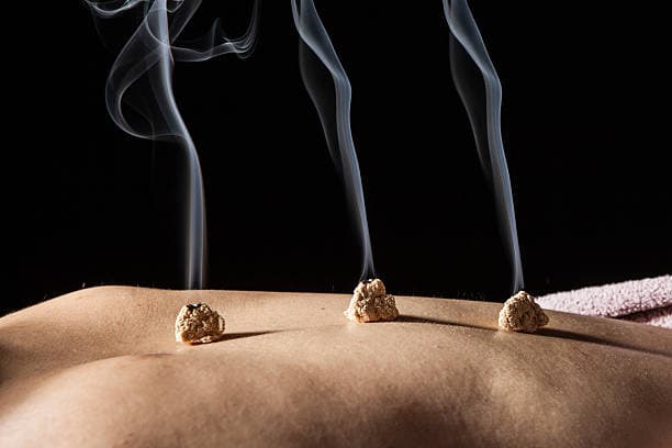 Acupuncture cost in Iran 