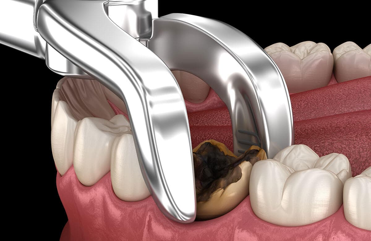 Tooth Extraction 