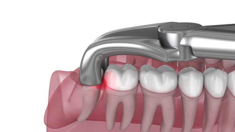 What is a tooth extraction?