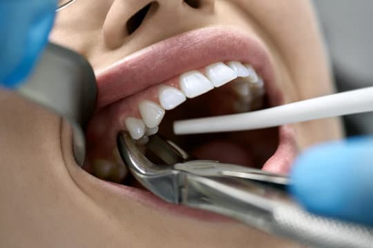 What is wisdom teeth removal?
