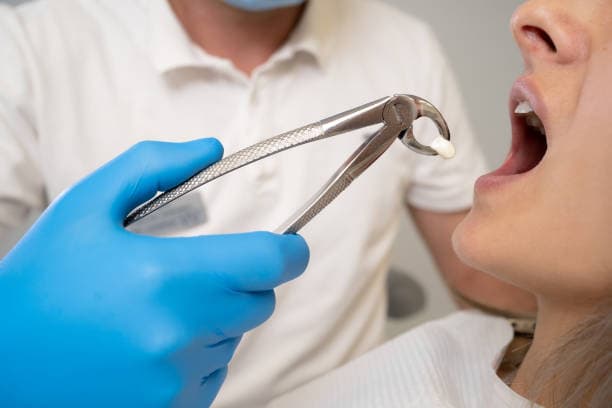 Do’s and don’ts after wisdom tooth extraction