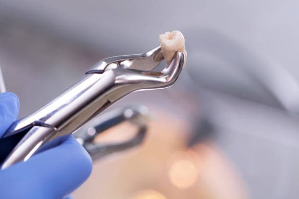 Tooth extraction aftercare