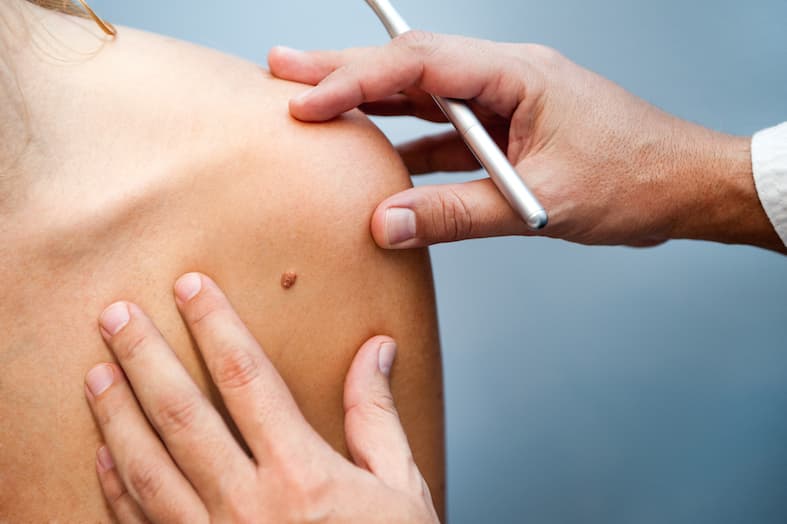 Mole Removal 