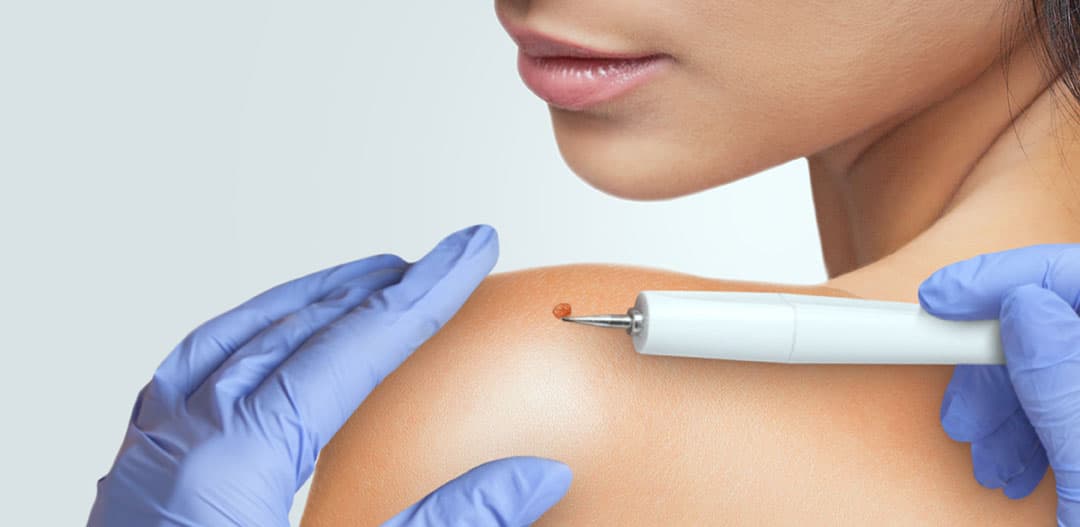 What is mole removal?
