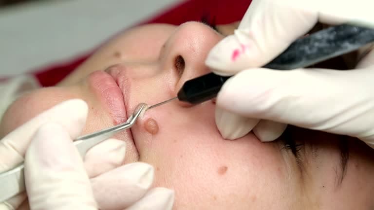 How are moles removed?