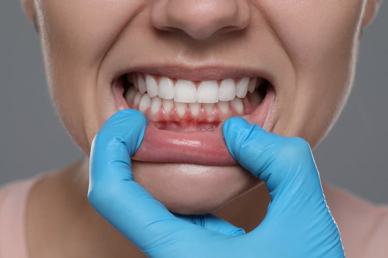 Periodontal treatment 