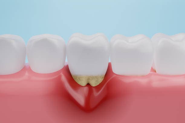 The symptoms of periodontal disease