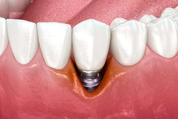 Periodontal disease stages 