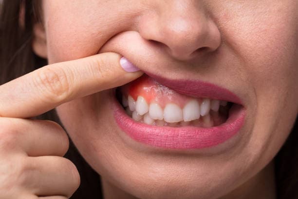 Diagnosing periodontal disease