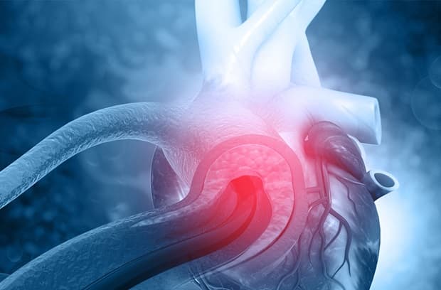 What are the risk factors for arrhythmia?