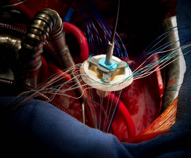 Arrhythmia Surgery Recovery