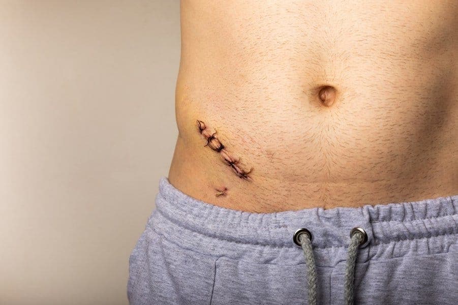 What is an appendectomy?