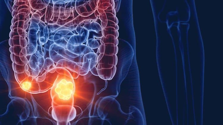 What are the signs you need an appendectomy?