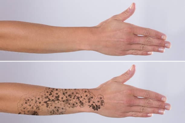 Skin tattoo removal
