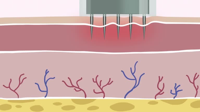 Who shouldn’t have microneedling?