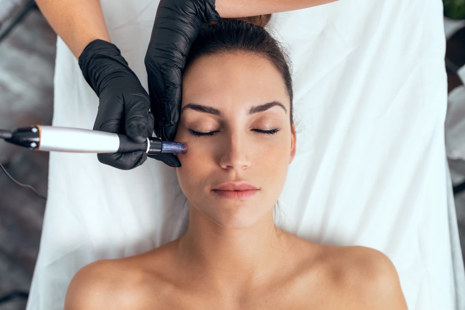 Microneedling cost in Iran
