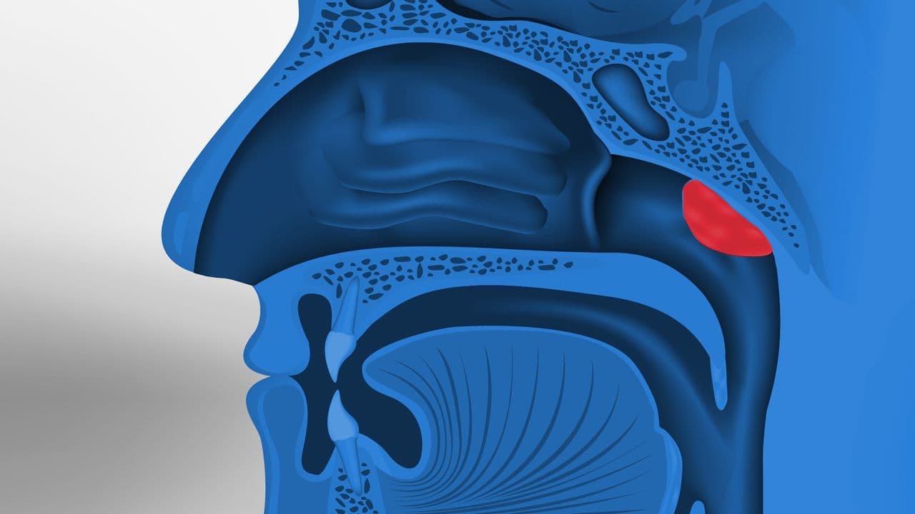 Adenoidectomy 