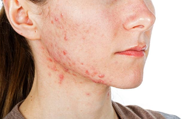Which parts of the body does acne affect?