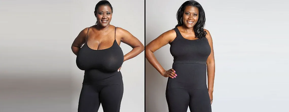 What is breast reduction?