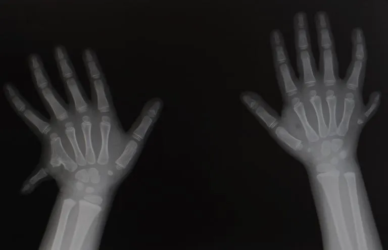 Polydactyly surgery cost in Iran