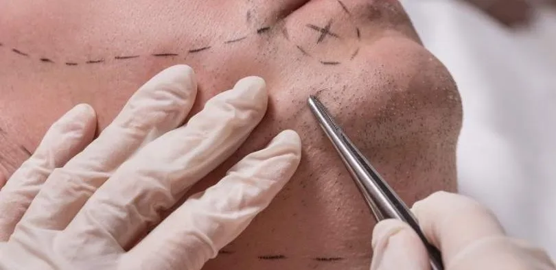 Type of Beard Transplant in Iran 