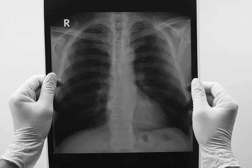 Lung Surgery Cost in Iran