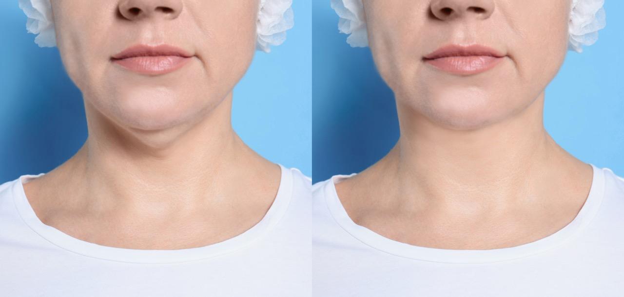 Double Chin Suction