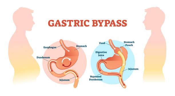 Gastric Bypass Pros & Cons