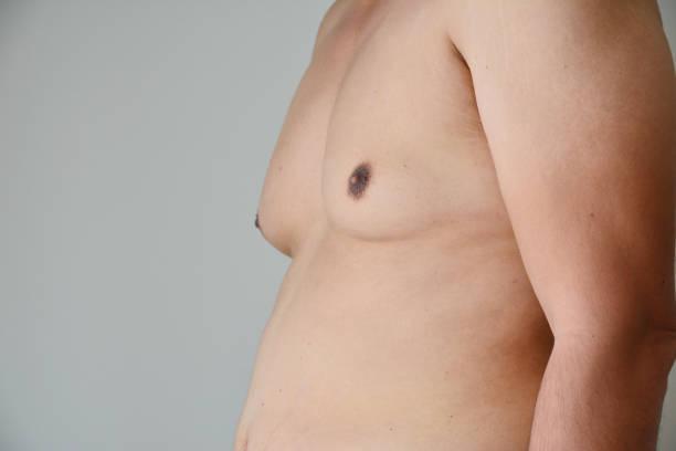 Grade IV- Advanced Gynecomastia