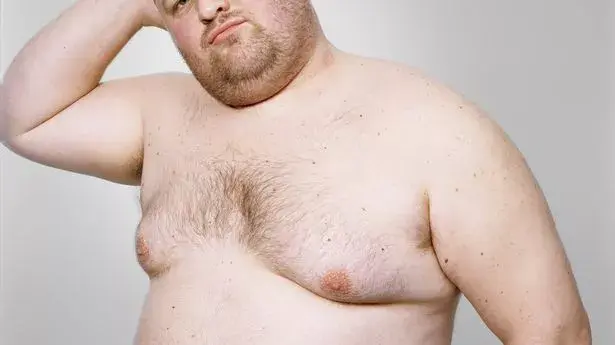 What is “gyno” (gynecomastia)?