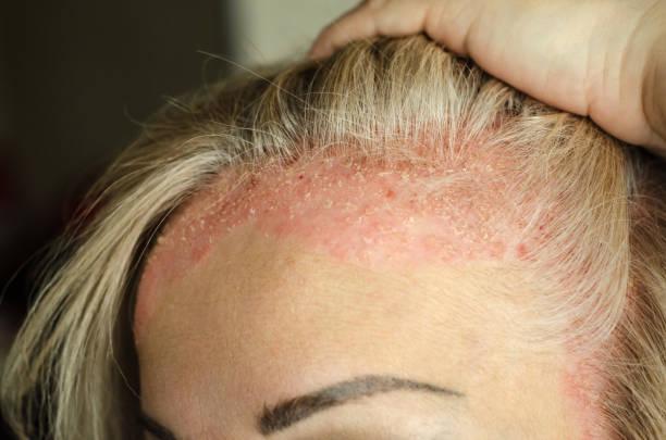 What are the signs & symptoms of Psoriasis?