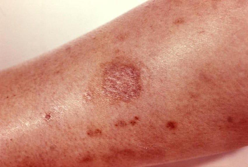 Coagulative Necrosis Treatment 