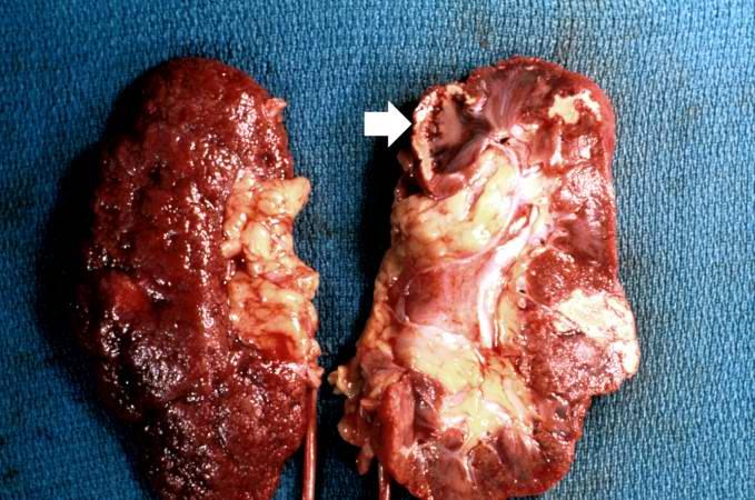 What are the types of necrosis? 