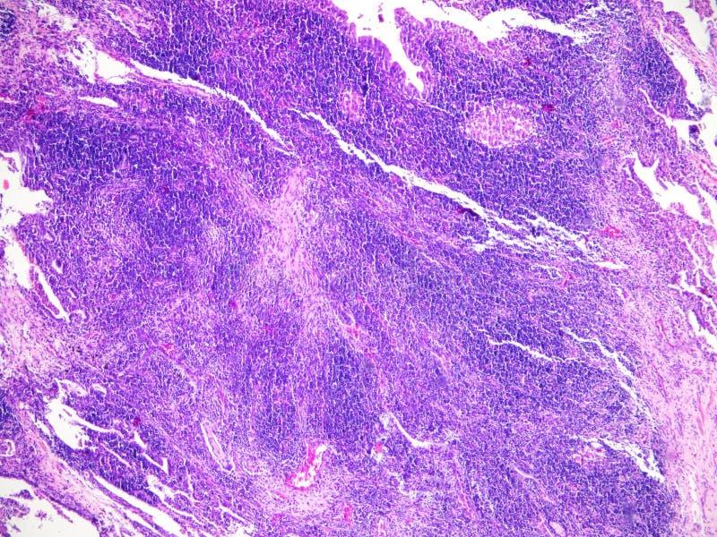 What are the symptoms of coagulative necrosis?