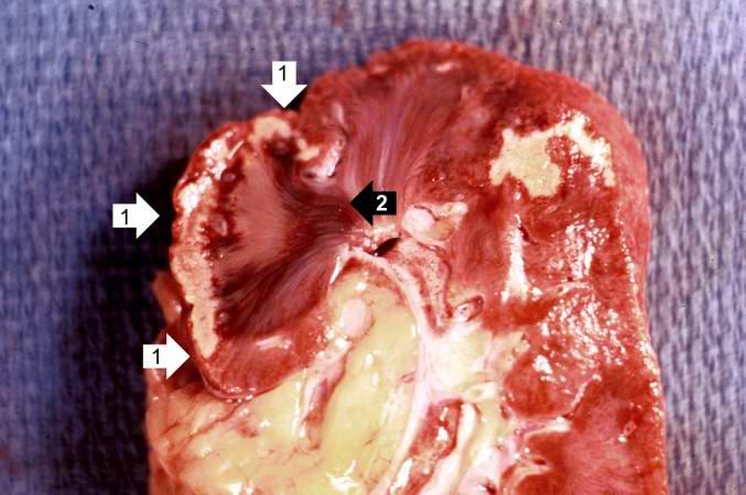 How is coagulative necrosis treated?