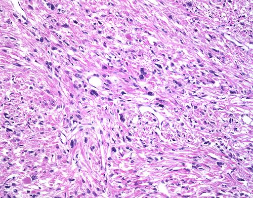 Coagulative Necrosis Treatment cost in Iran