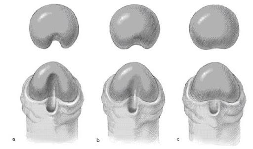 Hypospadias Treatment cost in Iran