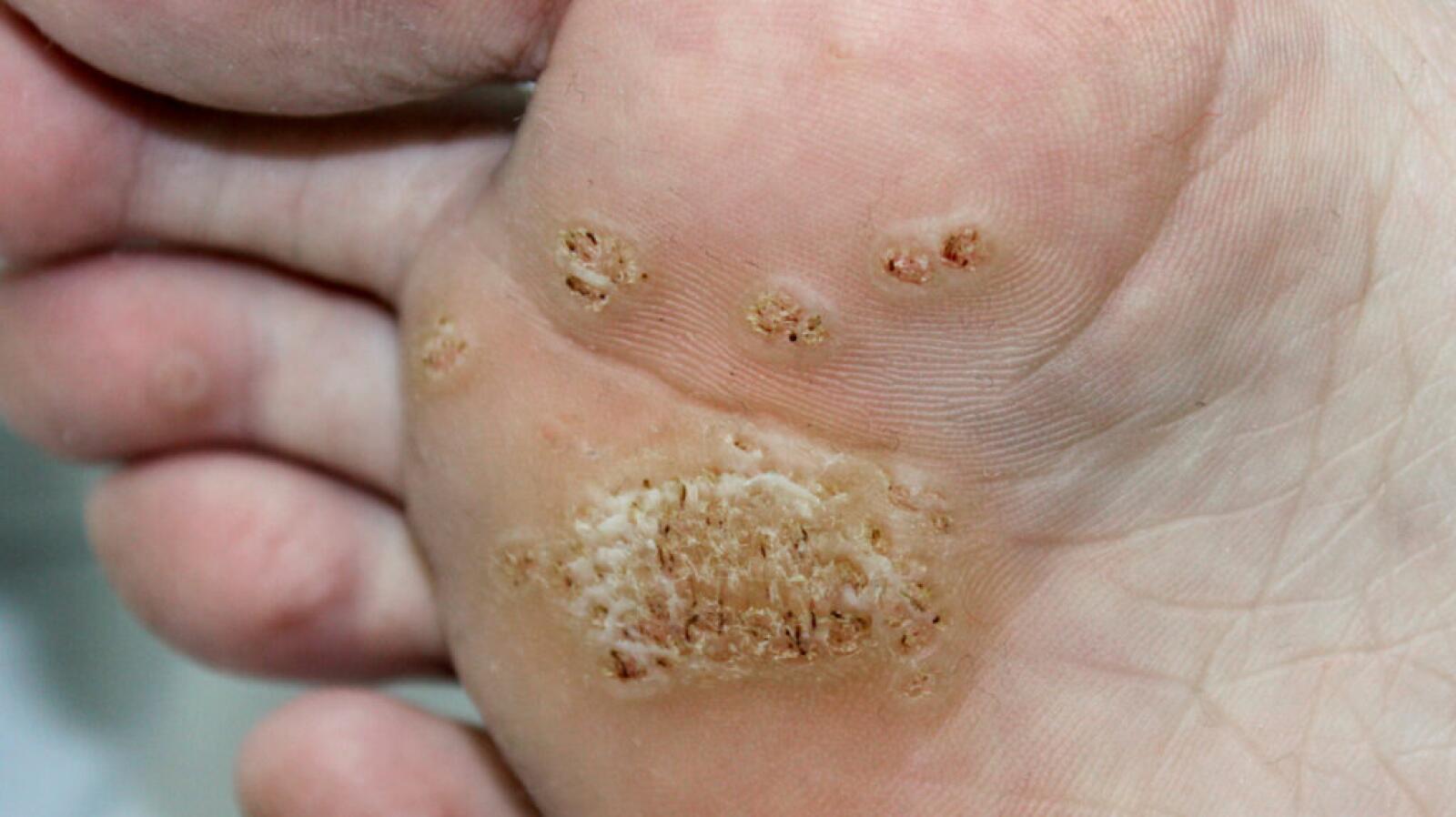 How to stop warts and verrucas spreading?