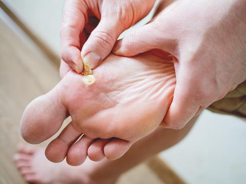 How are warts identified & treated?