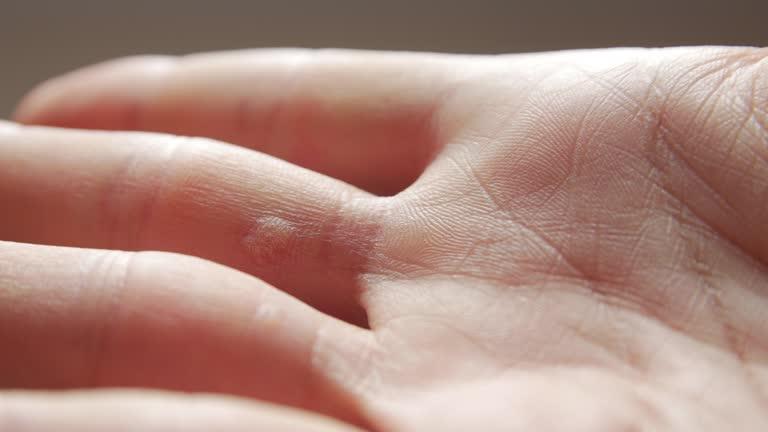 Why You Shouldn’t Leave a Wart Untreated?