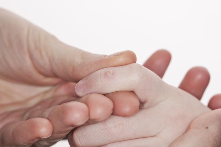 How can I prevent warts?
