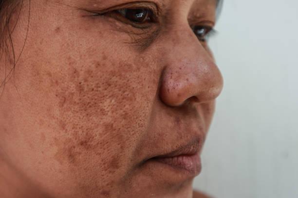 What is melasma?